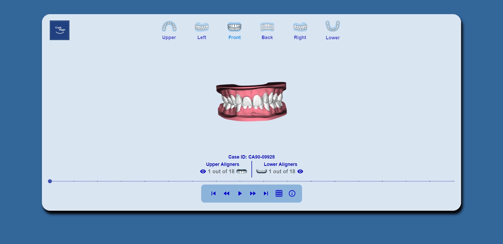 Front view of the case as scanned, upper and lower in occlusion.