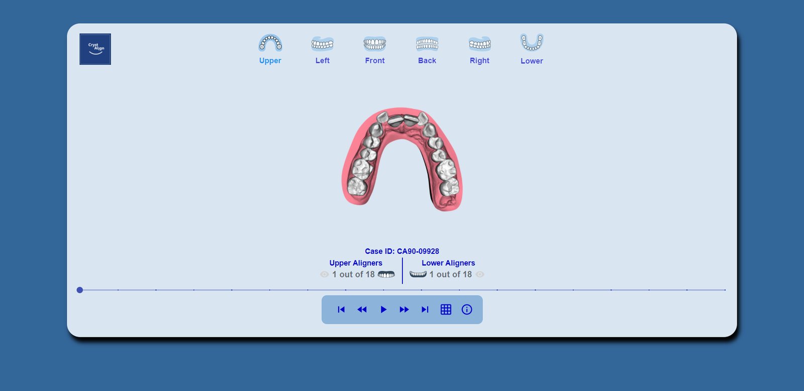 Upper arch from the occlusal, with the existing restorations visible.