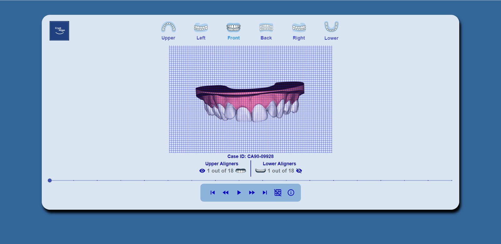 Upper aligner alone against the grid, seated over the crowns.